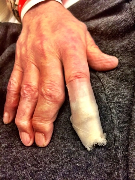 Never ask someone to heat your tea in a microwave & 
then check it with your finger if you can't see the surface.