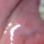 Got that much anaesthetic I've bit me flipping cheek 